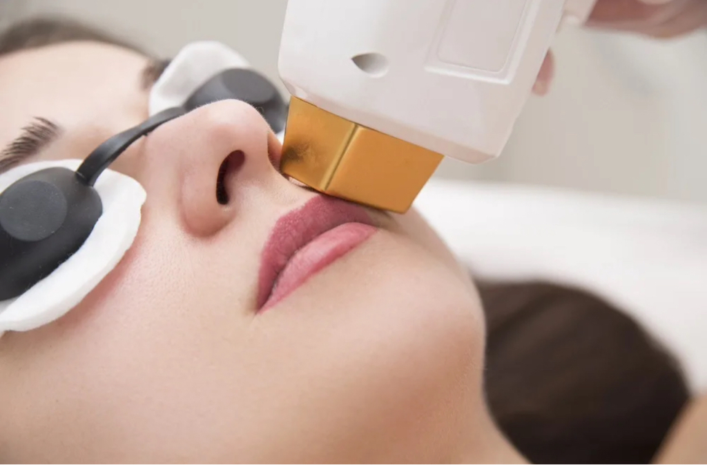 Верхняя Губа ( усики)  ( абонемент 4 процедуры)