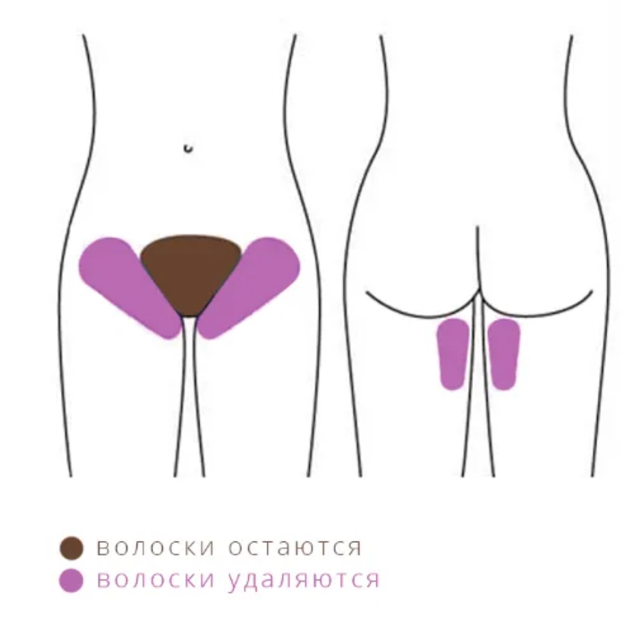 Бикини Классика (по линии белья+ часть лобковой зоны)