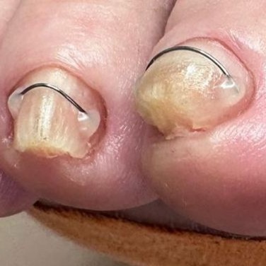 Установка титановой нити 2-4 маленьких ногтя