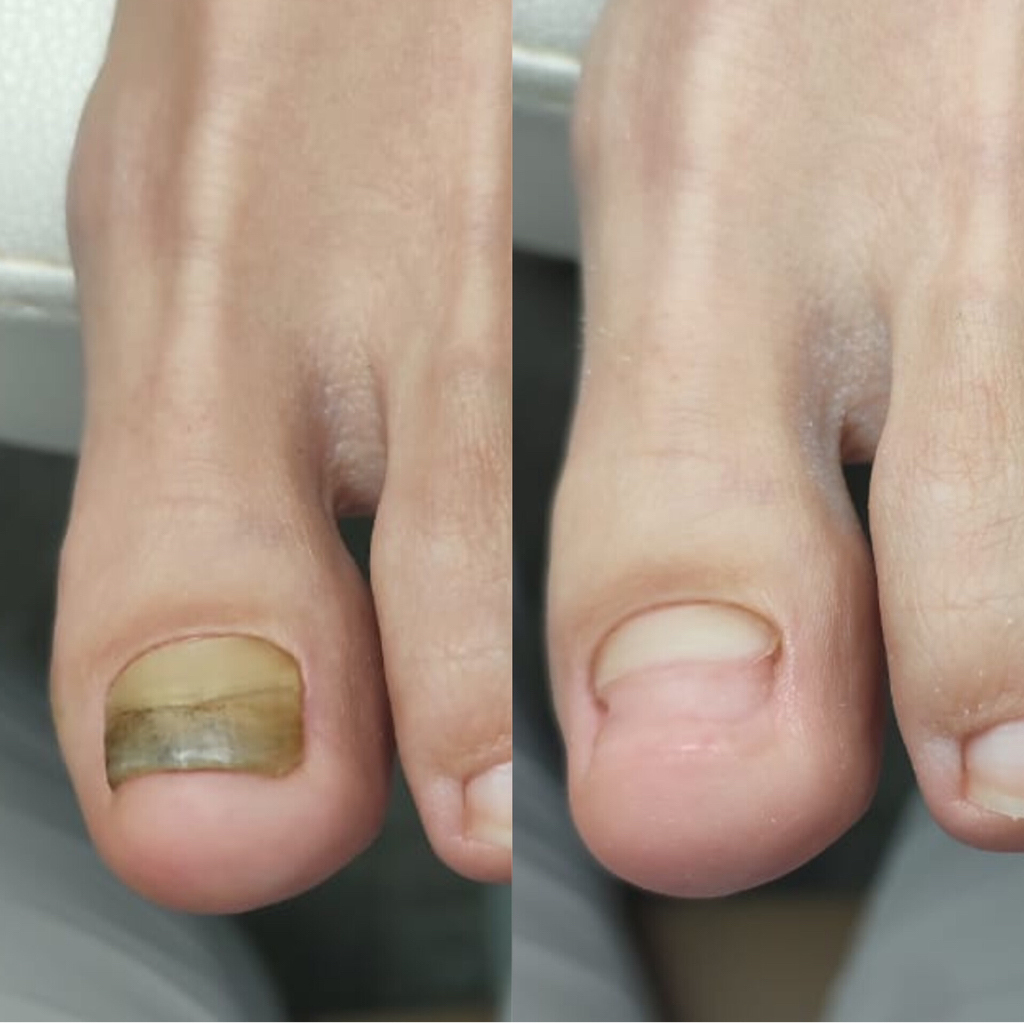 Частичная обработка 1 ногтя