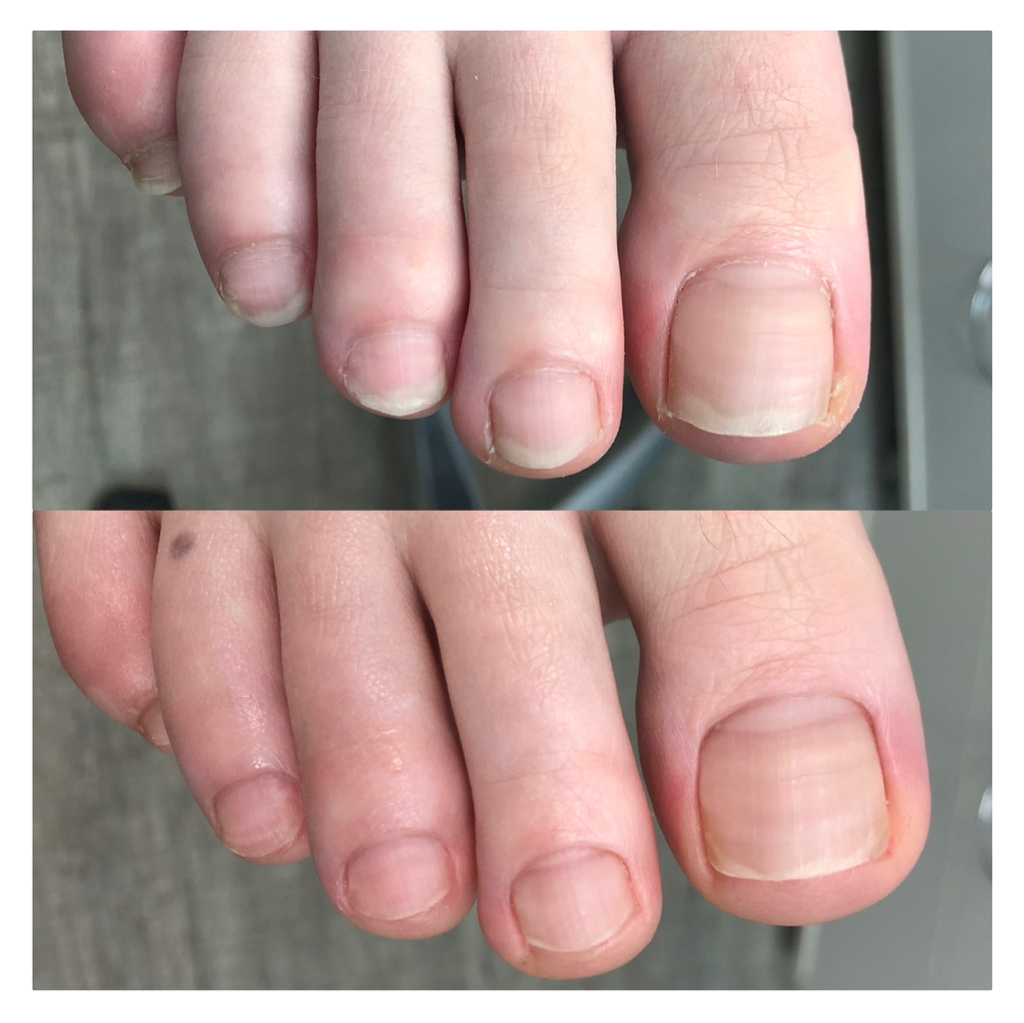 Обработка только ногтей(здоровых)