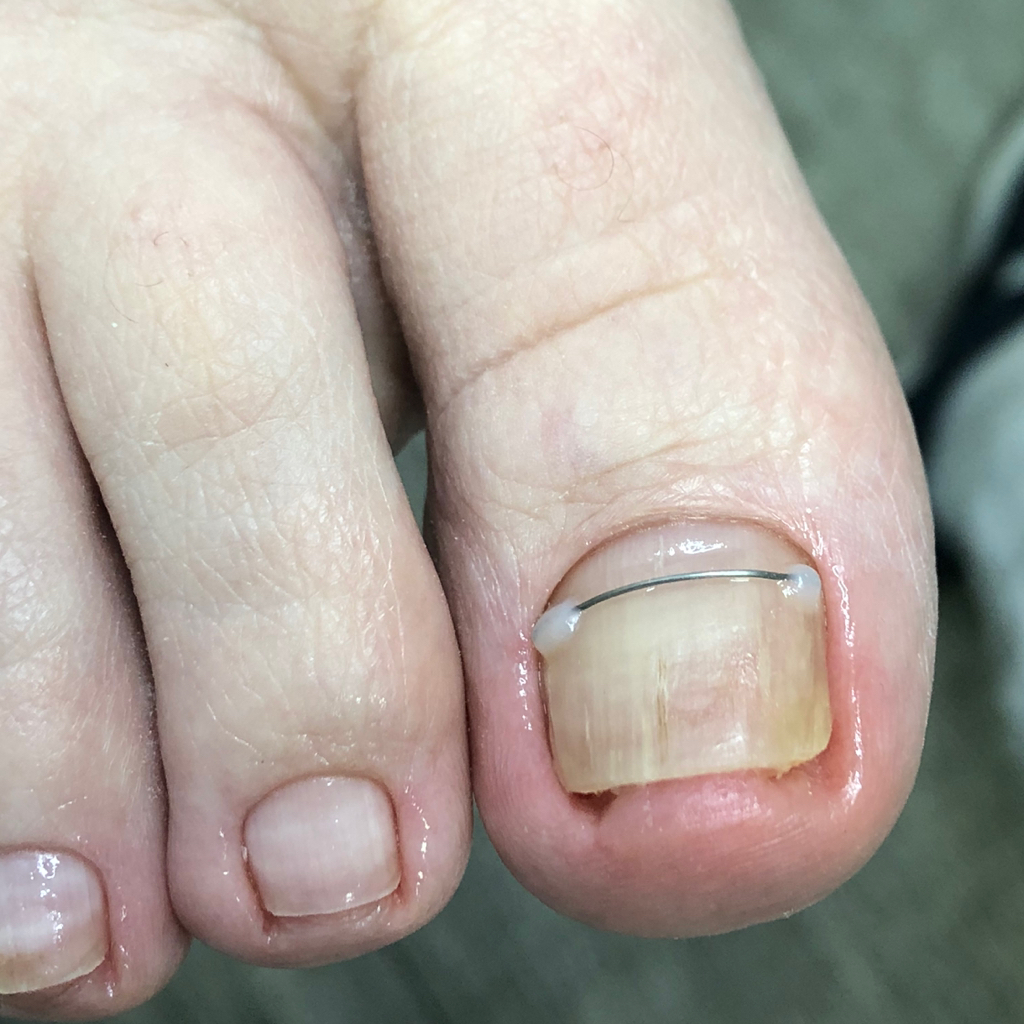 Установка КС «титановая нить»