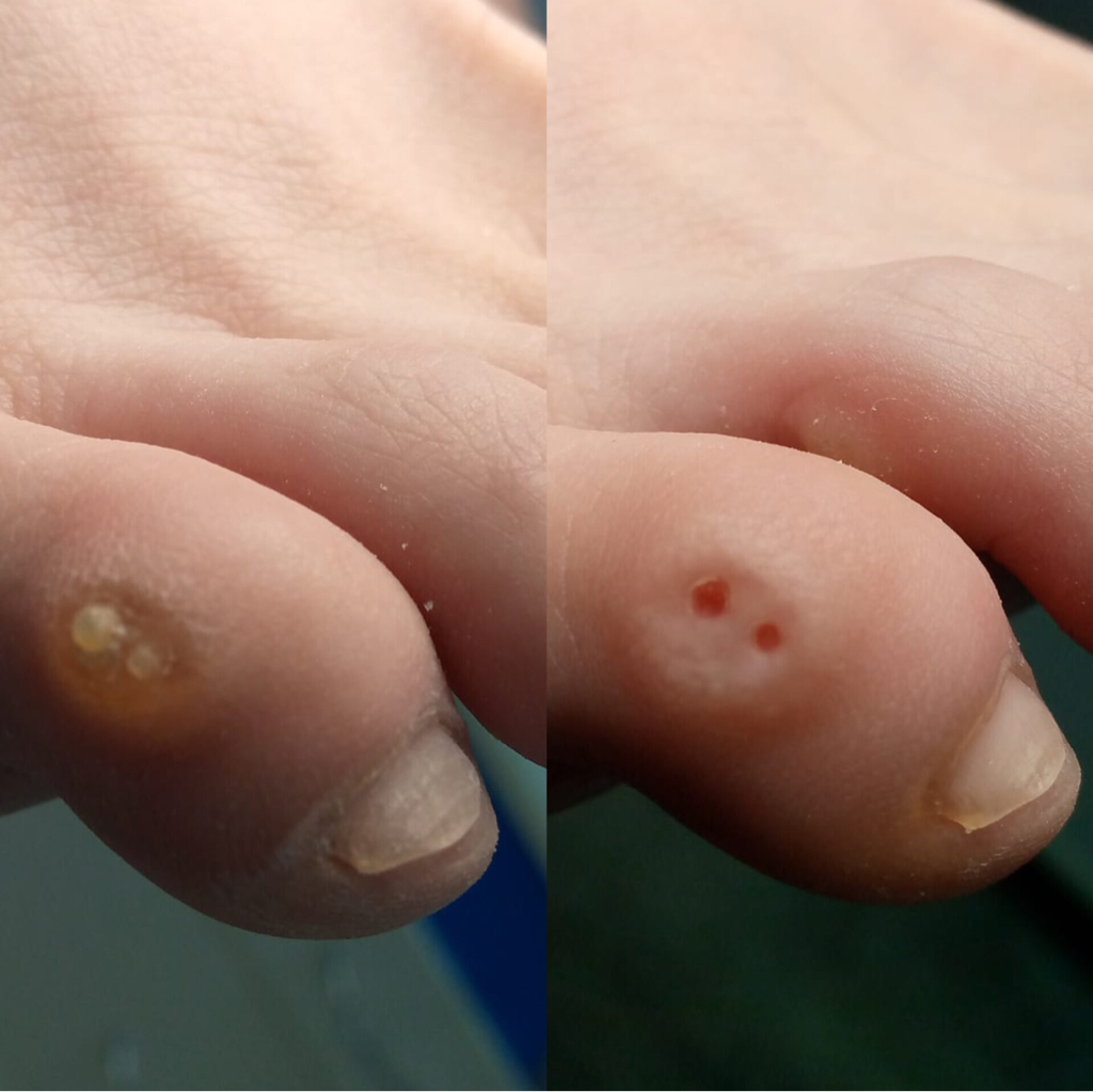 Обработка мозоли