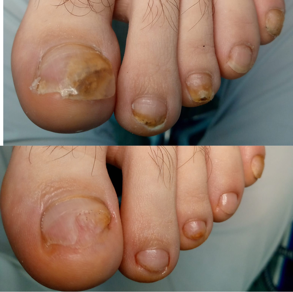 Частичная обработка от 2-5 проблемных ногтей