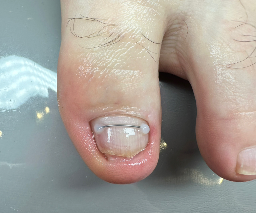 Установка коррекционной системы (на усмотрение специалиста)