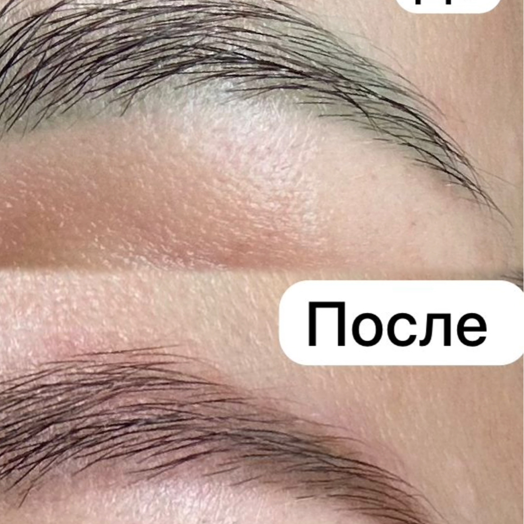 Удаление пигмента ремувером