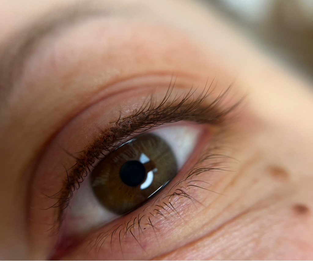 Коррекция межреснички