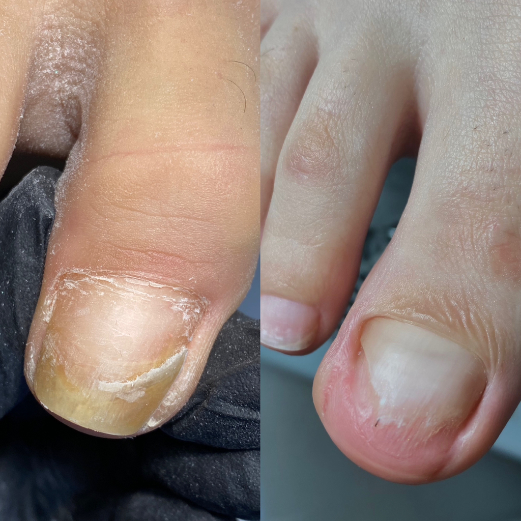 зачистка онихолизиса 1 ноготь