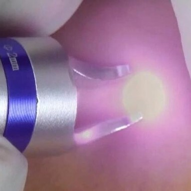 Склеротизация сосудистых образований