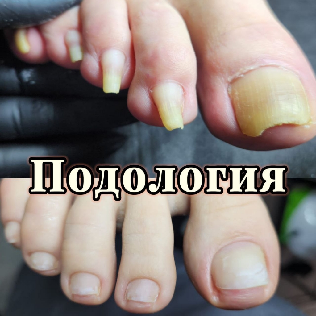 Подологический педикюр 2 и 3 сложности