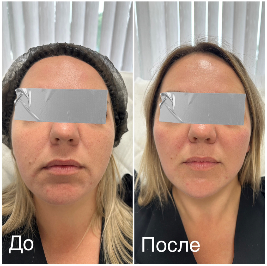 Full Face филлером