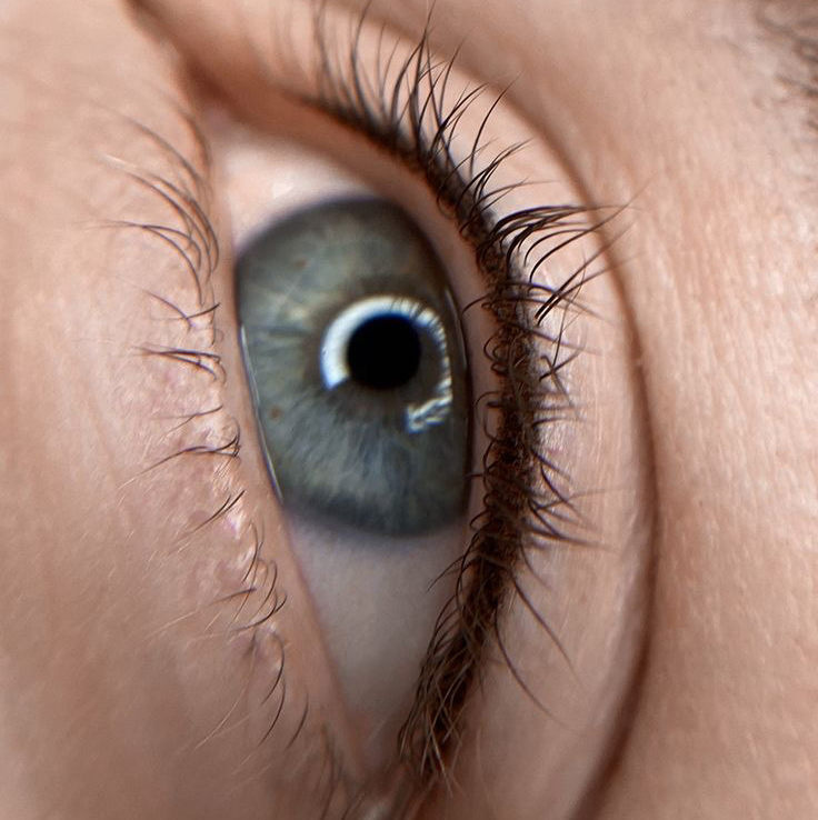 Межресничка