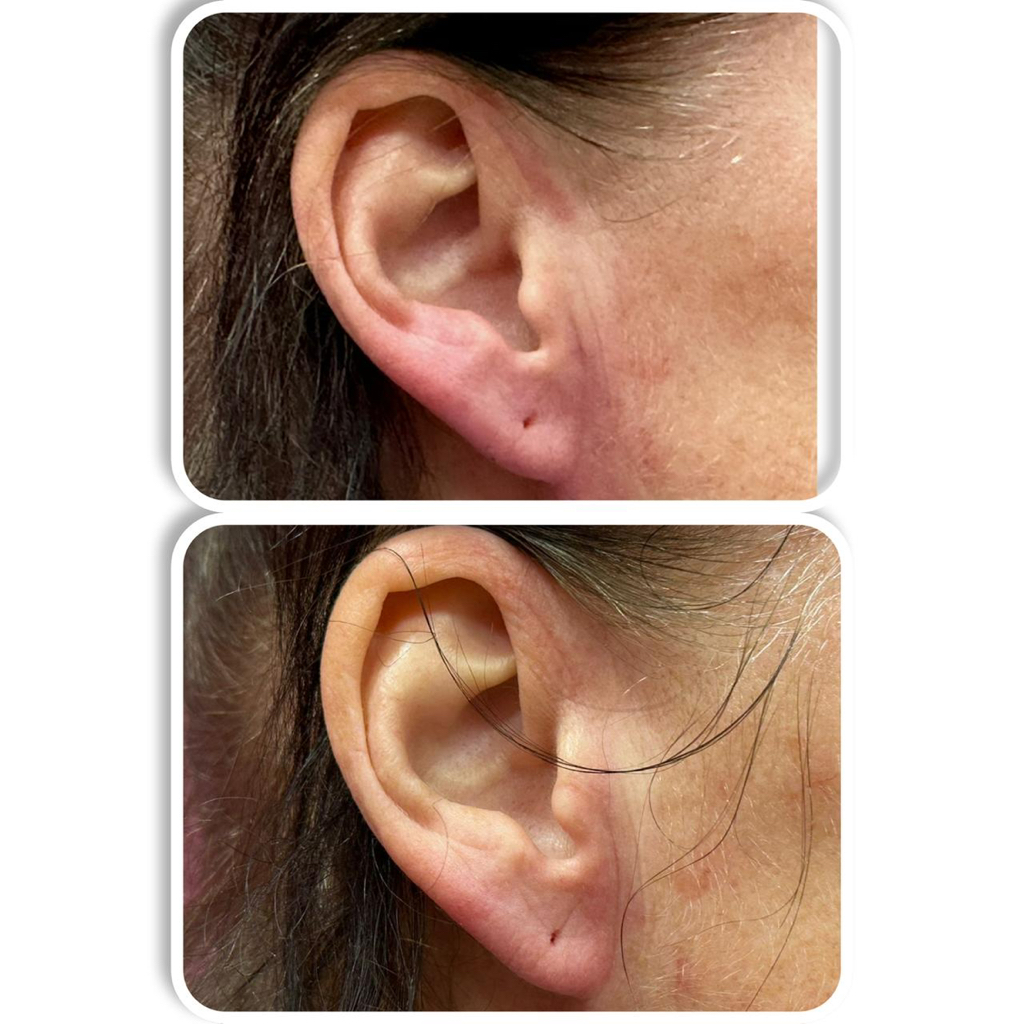 Контурная пластика ушей аппаратом Геалурон пен Без иглы