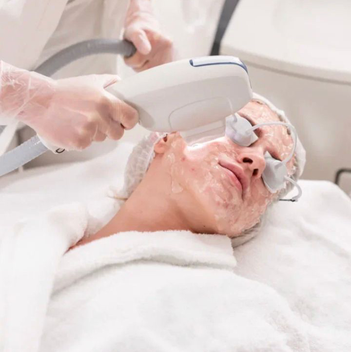 Фотоомоложение (Пигментация,морщины,акне)