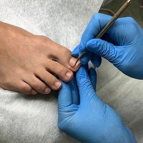 Smart-педикюр (сложные стопы)