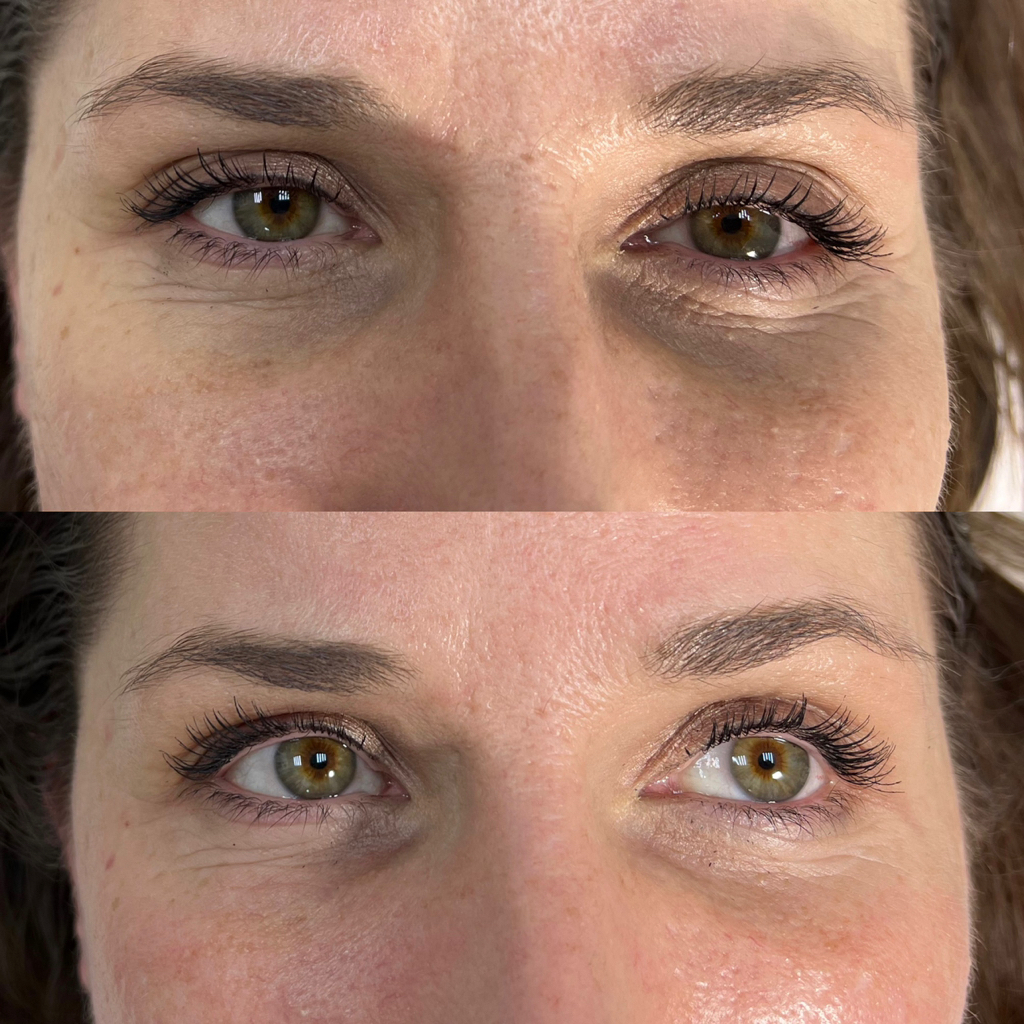 Контурная пластика носослезной борозды