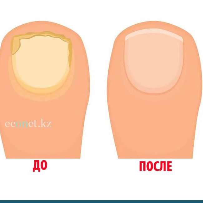 Медицинский педикюр