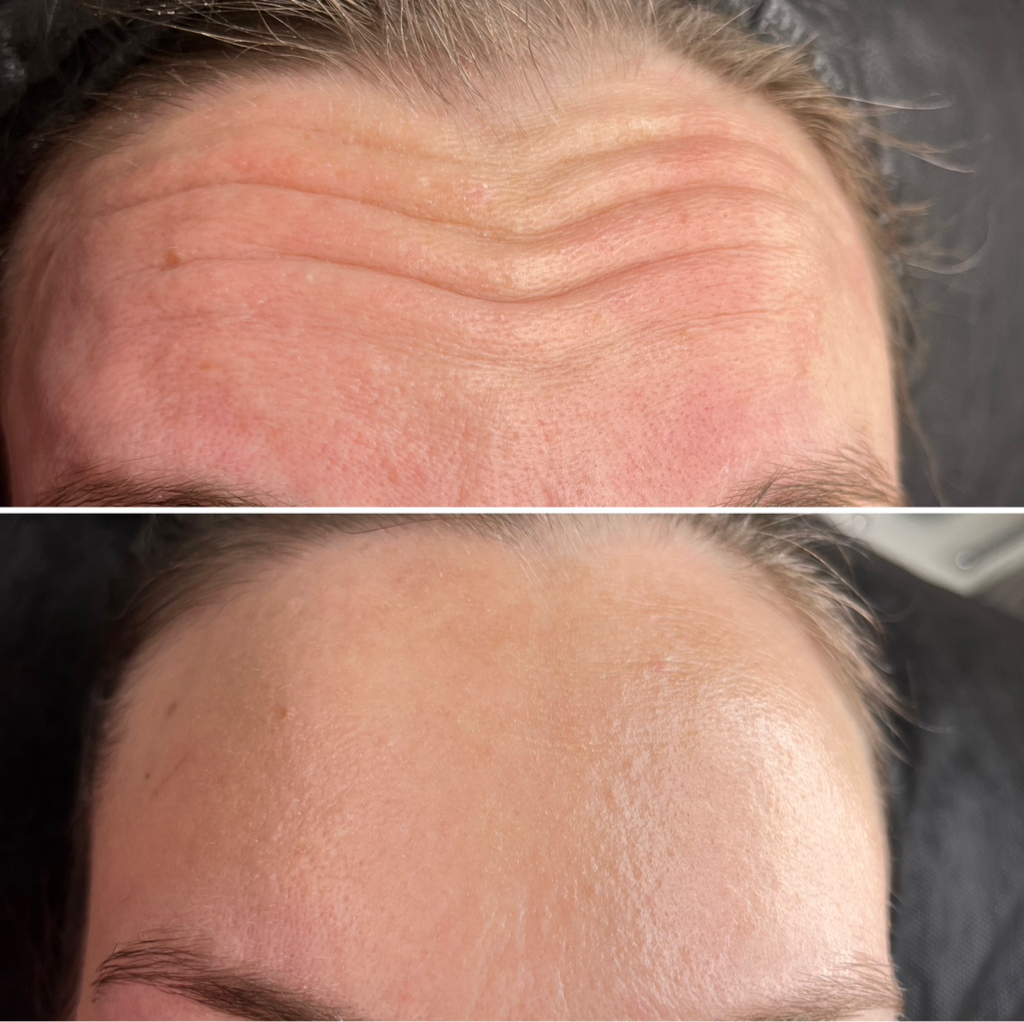 Ботулотоксин верхней трети лица  Лоб+межбровка+глаза