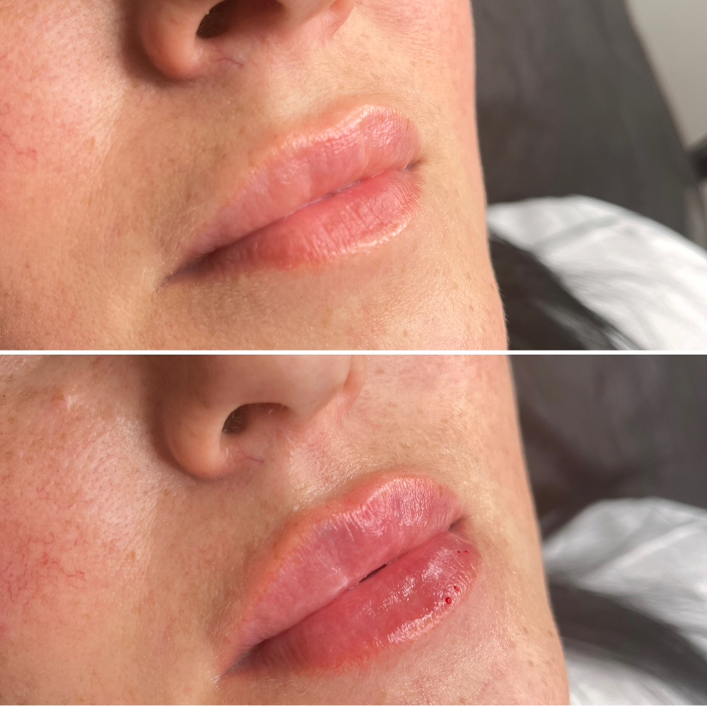 Контурная пластика губ