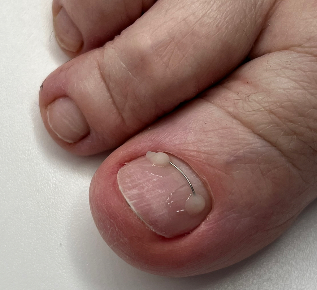 Постановка титановой нити