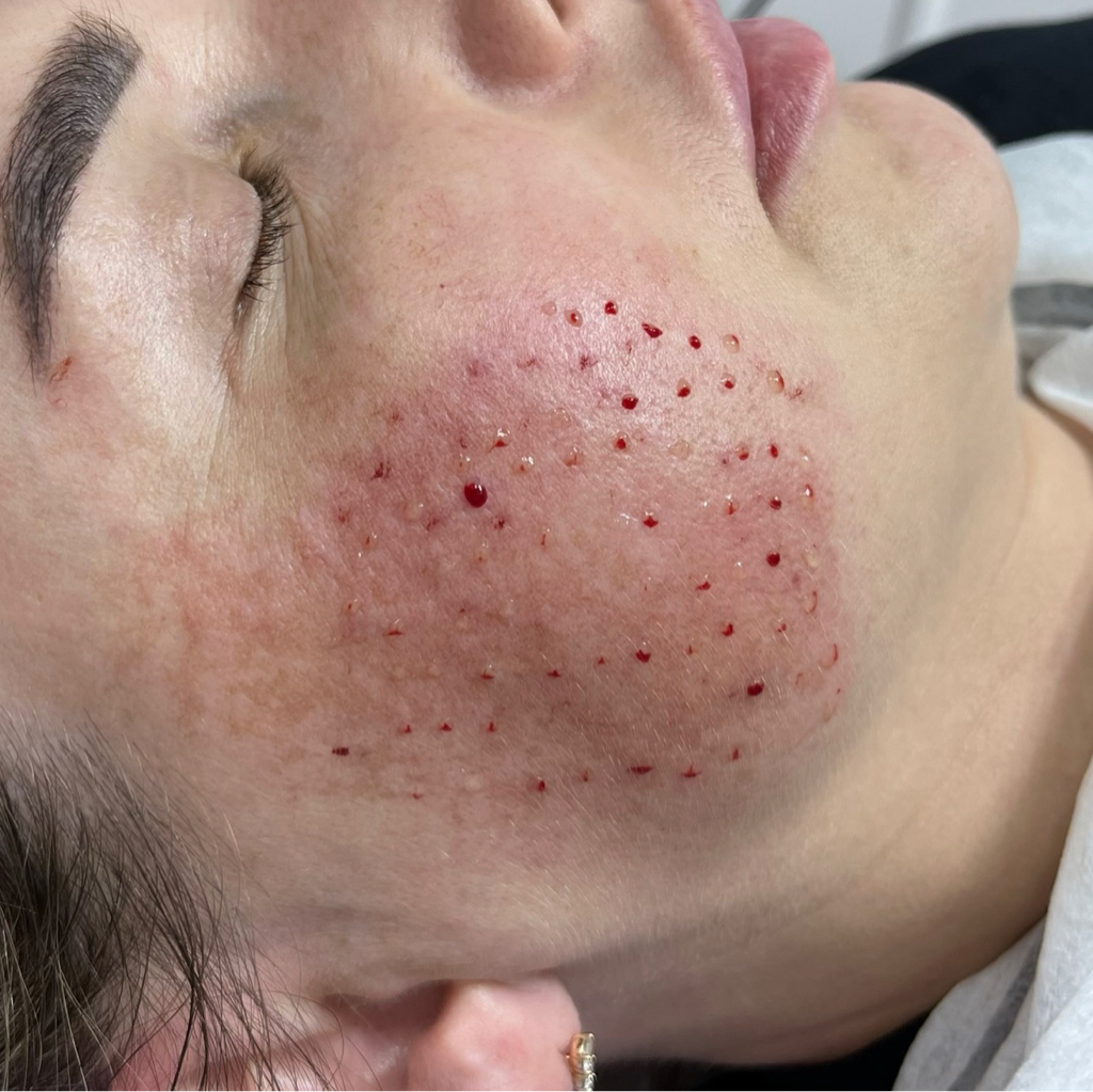 Мезотерапия век, лица, шеи