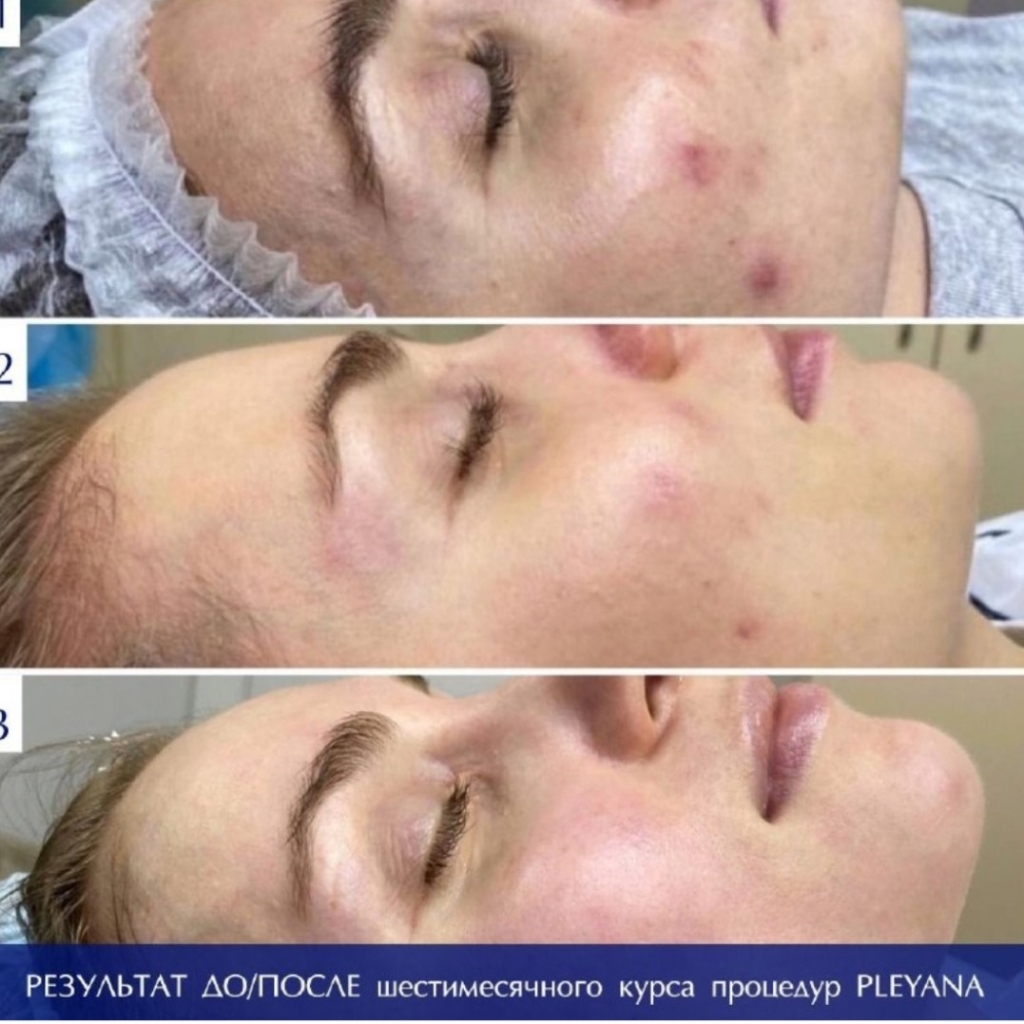Мультифруктовый пилинг(до 21 года)