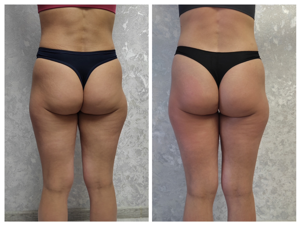 Антицеллюлитный массаж