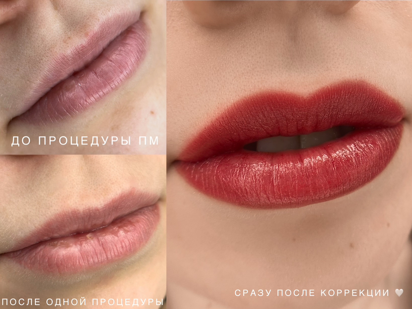 Коррекция ПМ губ