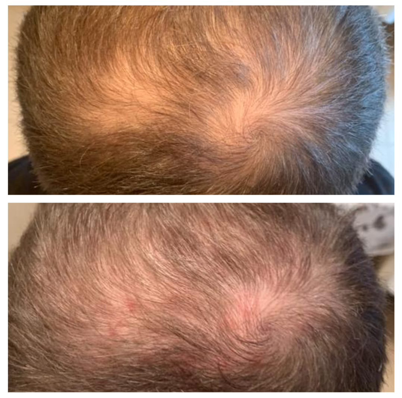 Мезотерапия кожи головы