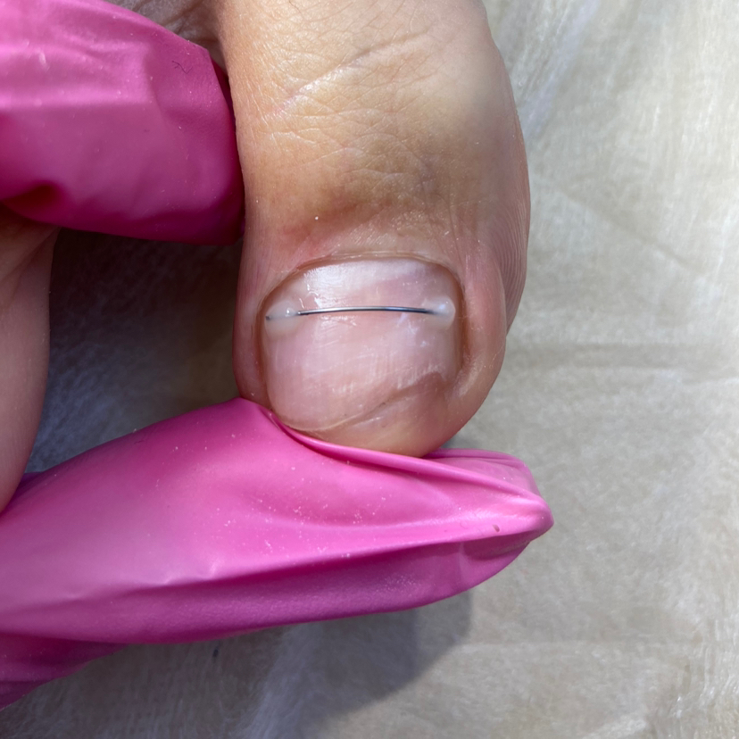 Повторная установка Титановой нити