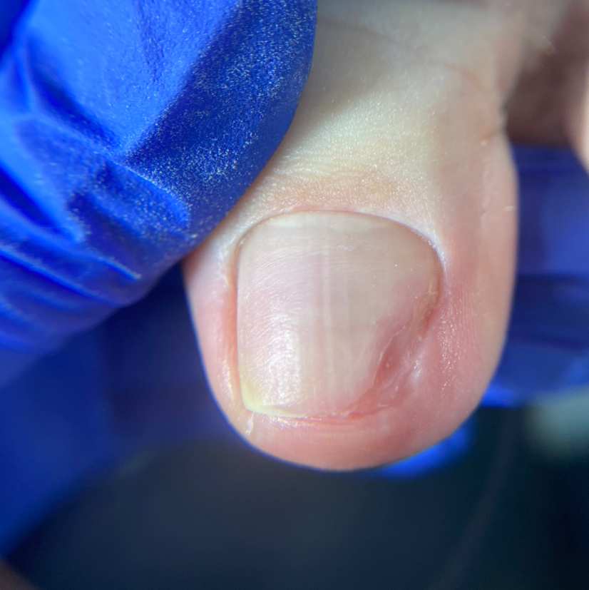 Зачистка сложного онихолизиса