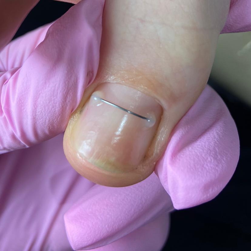 Установка титановой нити