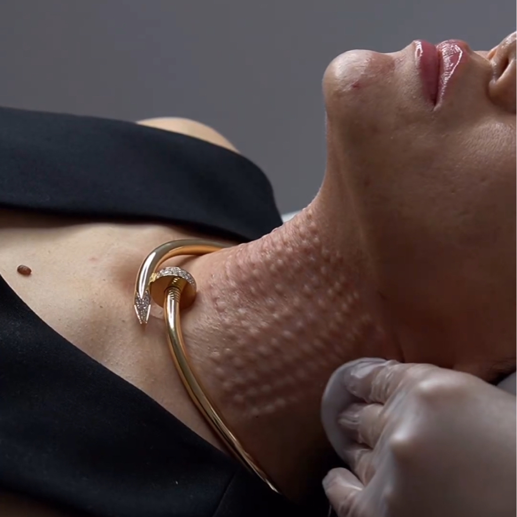 Биоревитализация шеи