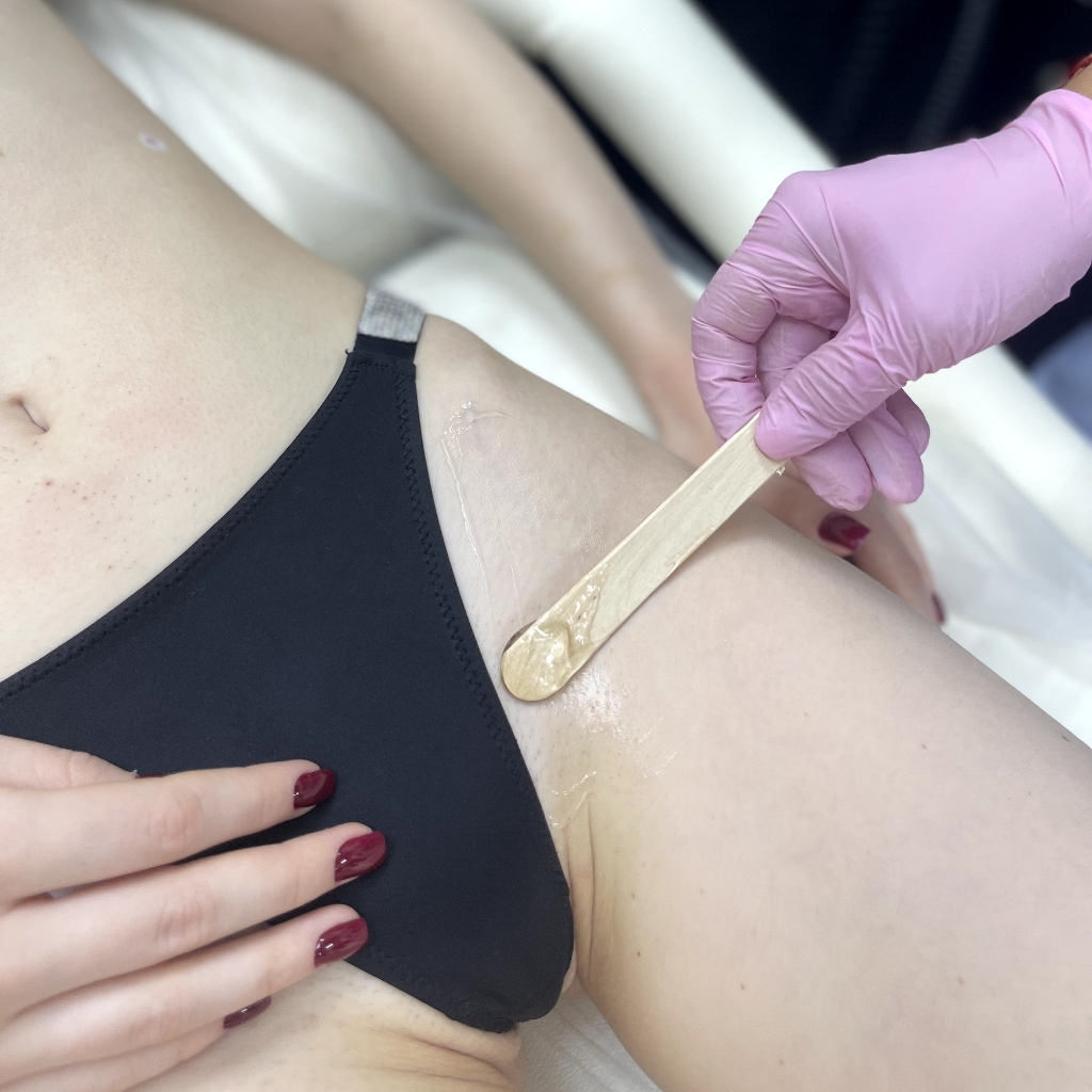 Глубокое бикини - лазерная эпиляция