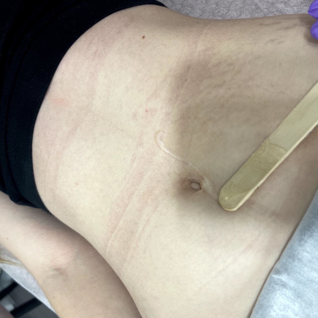 Белая линия живота - лазерная эпиляция