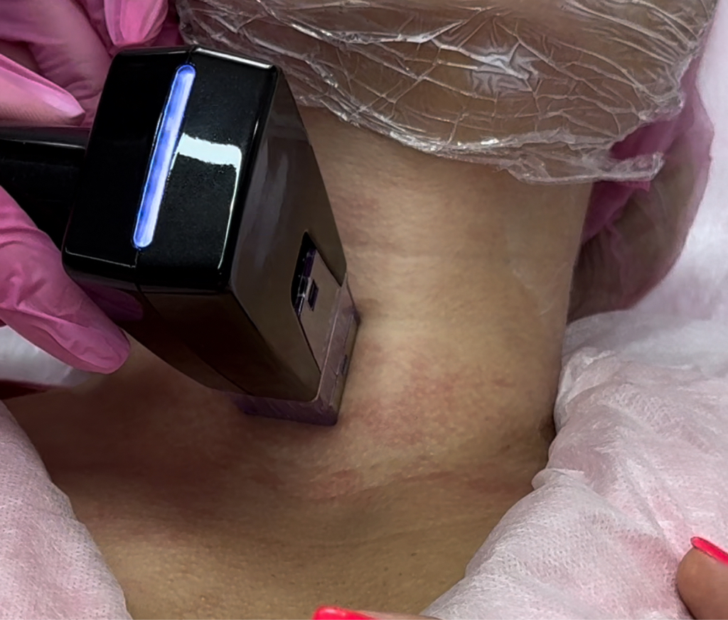 Фракционный игольчатый Rf-лифтинг ( шея+ глаза)