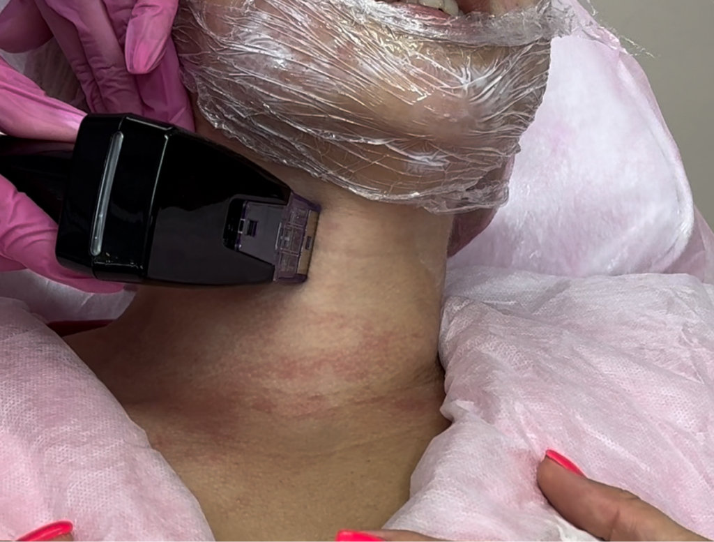 Фракционный игольчатый Rf-лифтинг ( лицо + шея+ декольте)