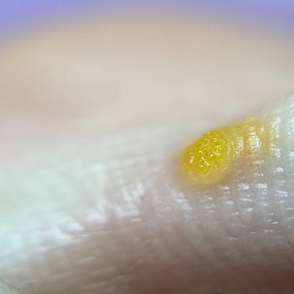 Вторичный прием бородавки