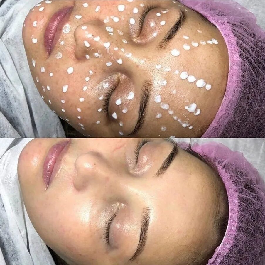 Ультразвуковой лифтинг лица 