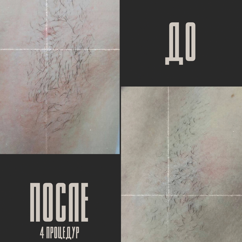 Подмышечные впадины