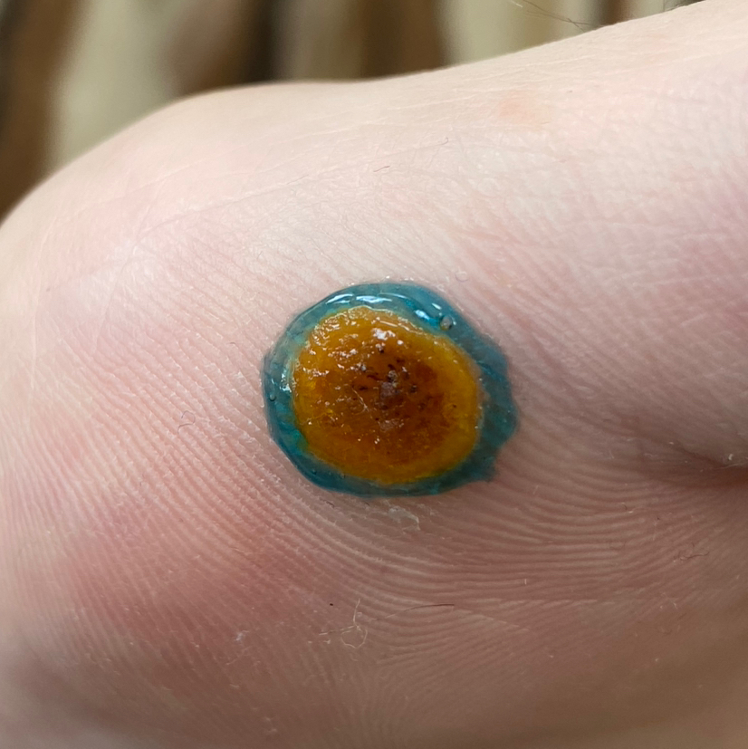 Обработка бородавки