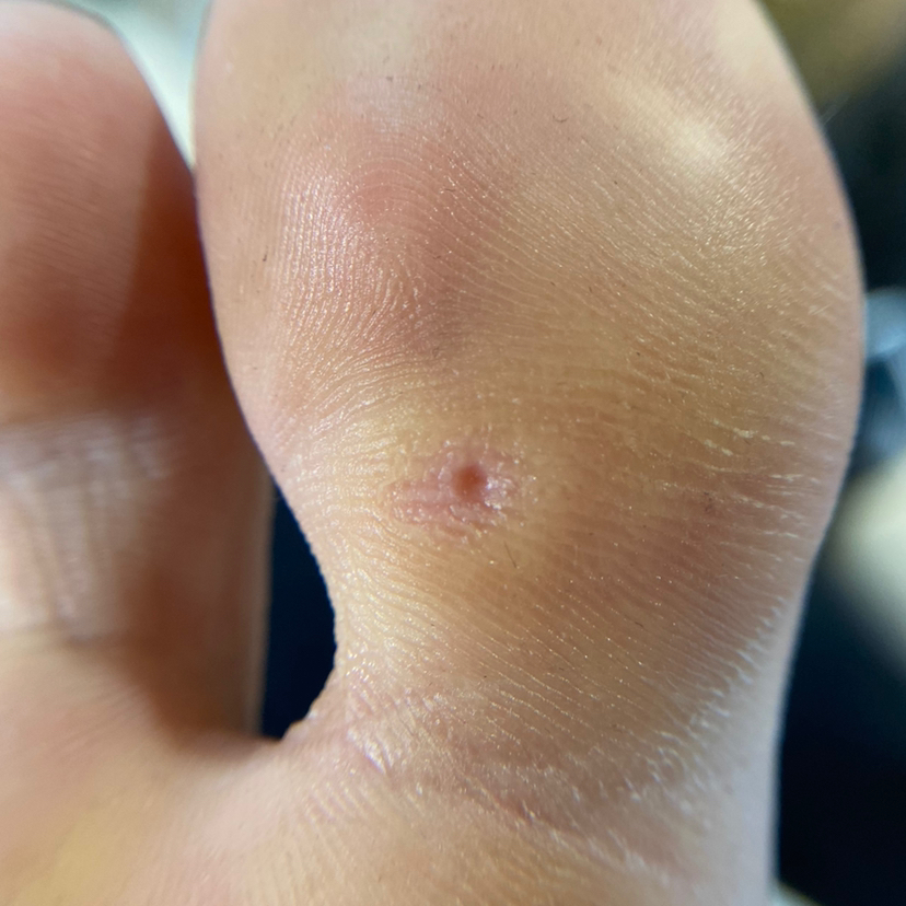 Обработка мозолей