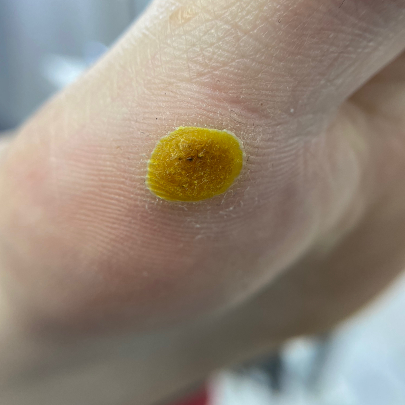 Обработка бородавки (повторно)