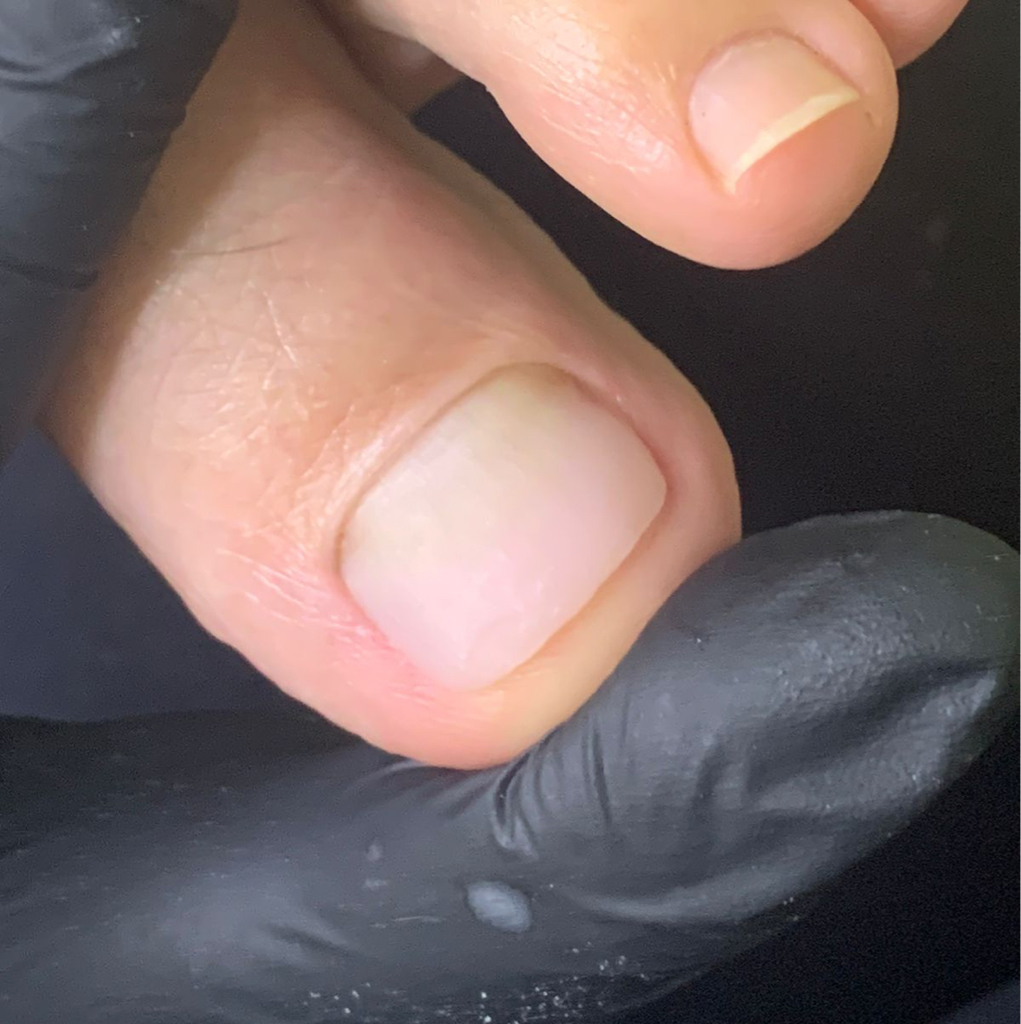 Протезирование ногтевой пластины на ногах