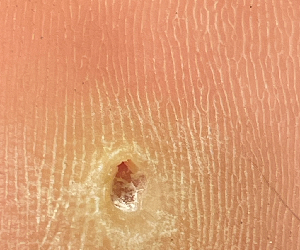 Медицинский педикюр.