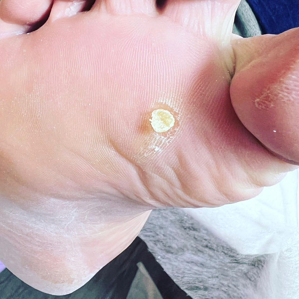 Обработка стержневой мозоли