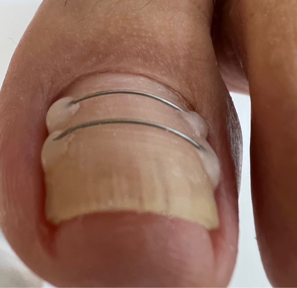 Титановая нить