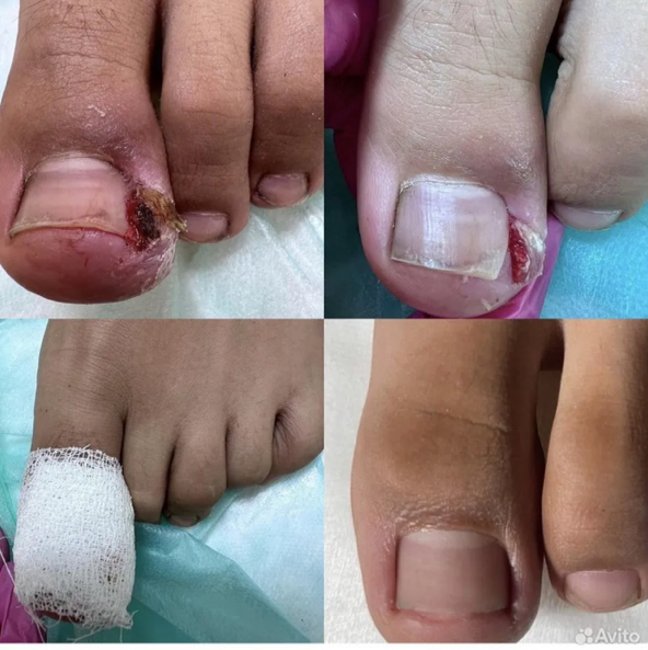 Коррекция вросшего ногтя