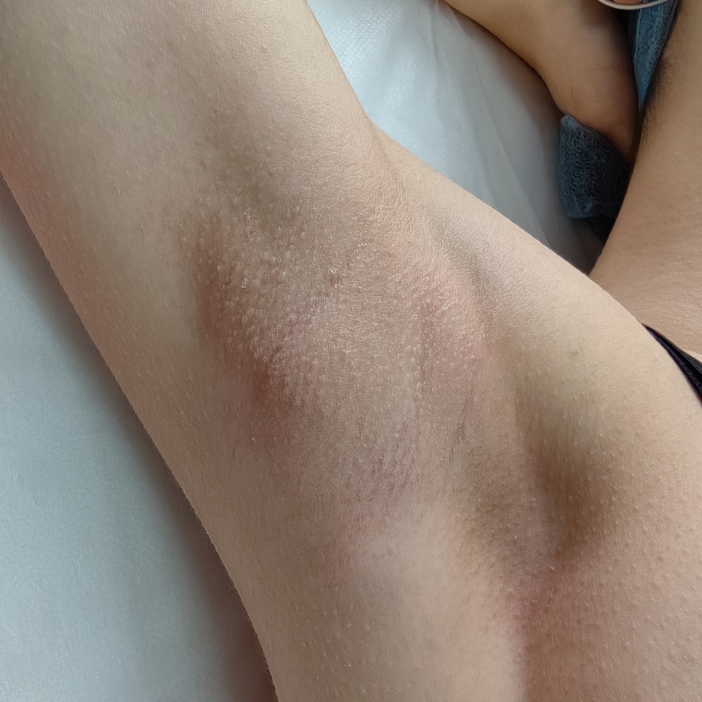 Подмышечные впадины