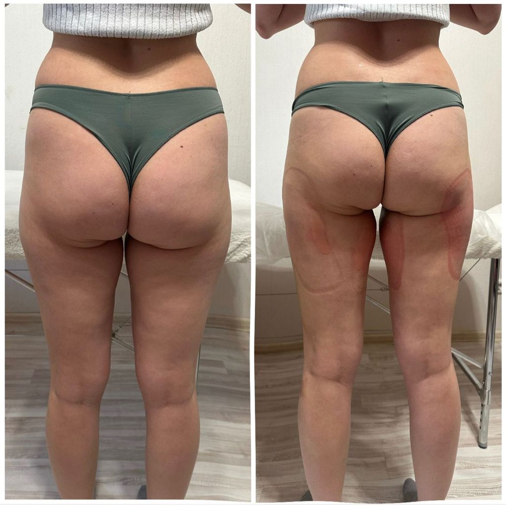 Криолиполиз 4 насадки